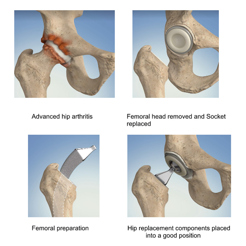 total hip replacement image showing the stages of surgery in hip replacement from arthritis stage through to hip replacement